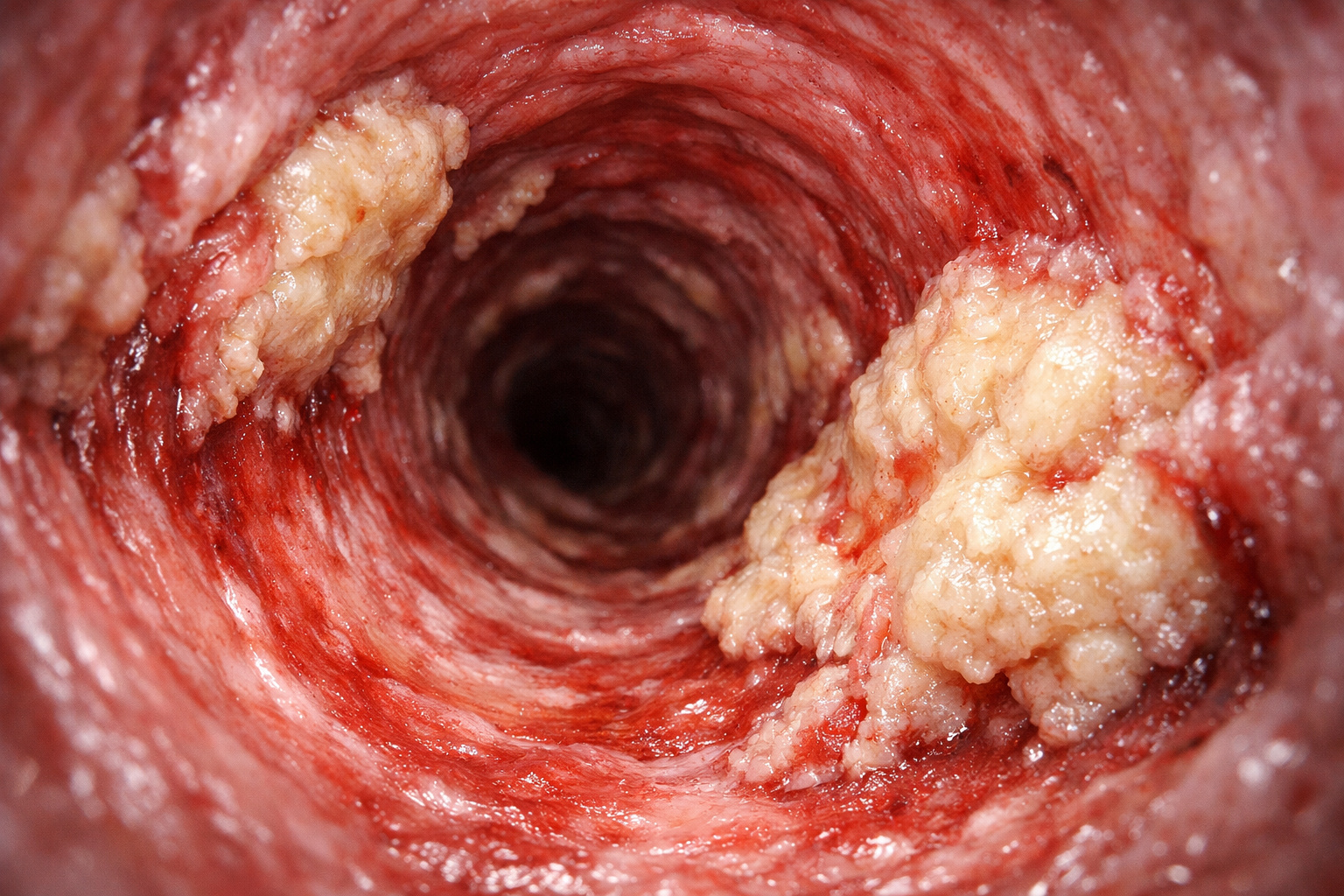 Imagem do interior de uma artéria coronária mostrando placas antes e depois do tratamento com inibidores de PCSK9.