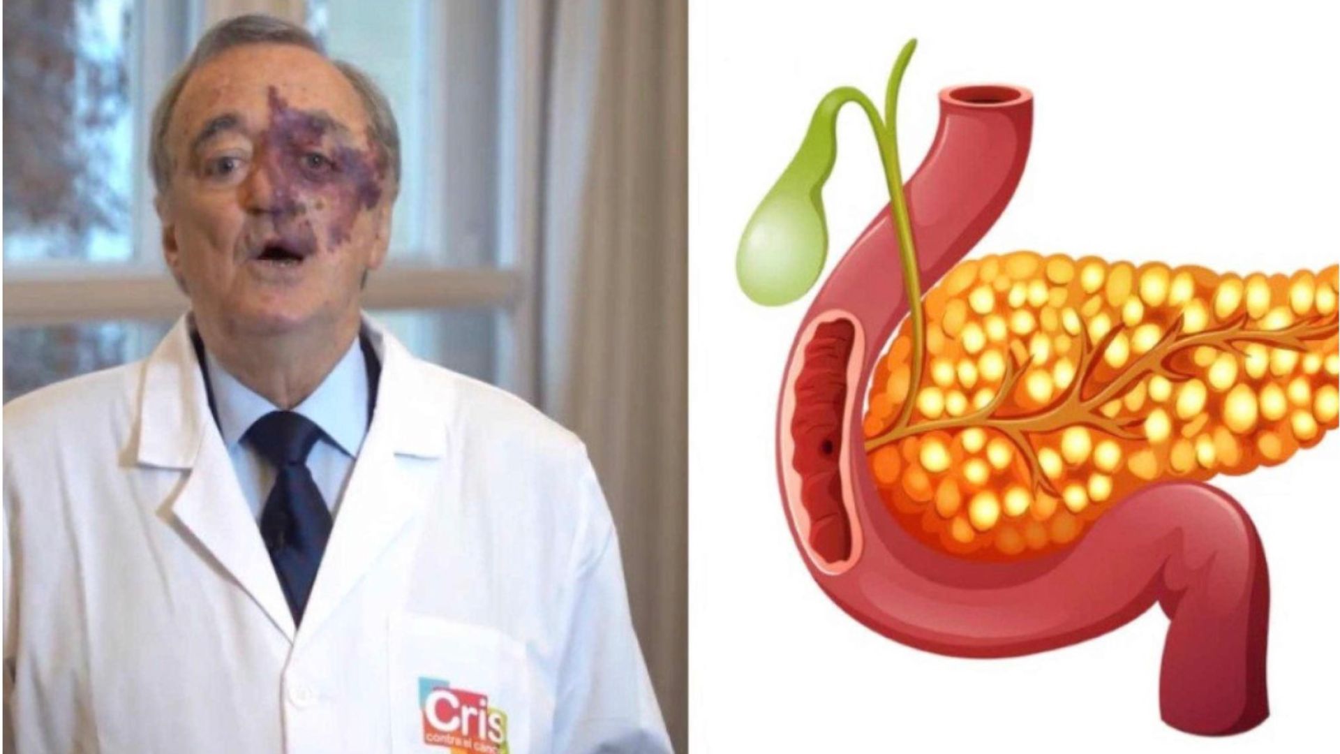 Cientistas analisam tratamento inovador contra câncer de pâncreas